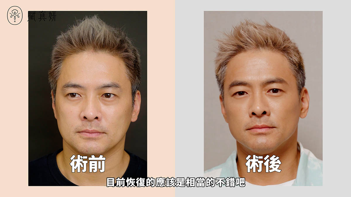 賦真妍眼袋手術 5